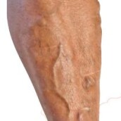 Od metliček ke křečovým žilám